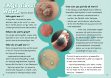 Faqs about warts.